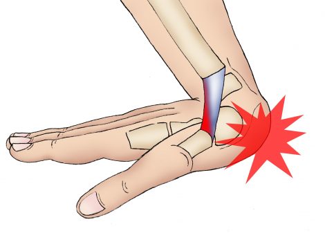 پیچ‌خوردگی مچ دست